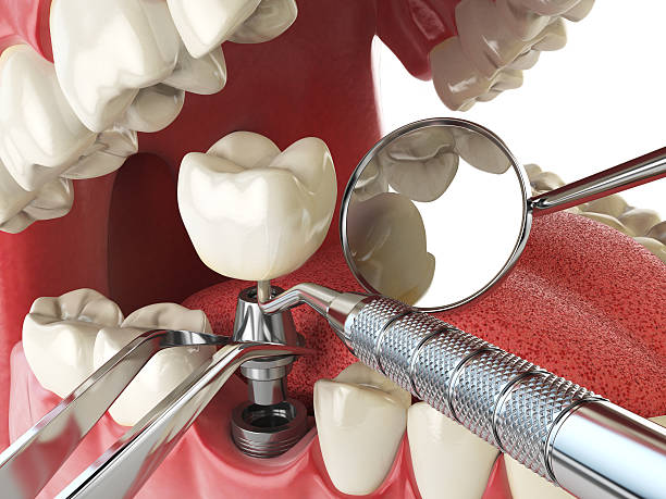 Best Emergency Denture Repair in Cashmere, WA